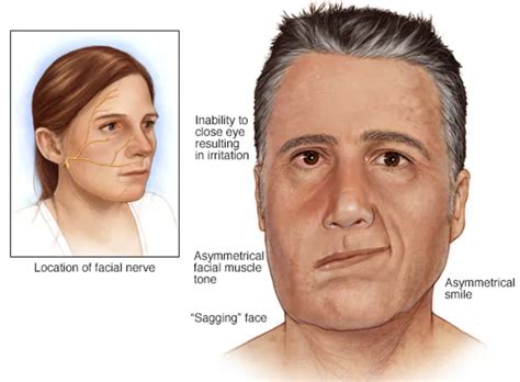 Facial Paralysis Causes Treatment Md Burak Sercan Er In