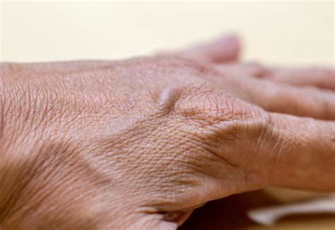 Causes And Effective Treatment Of Bulgy Hand Veins Dr Nina Skin