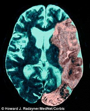 Patients left paralysed after a stroke can now move again ...