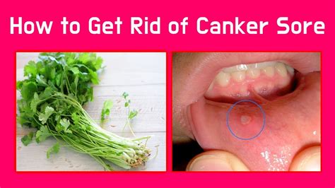 How To Get Rid Of Canker Sore Youtube