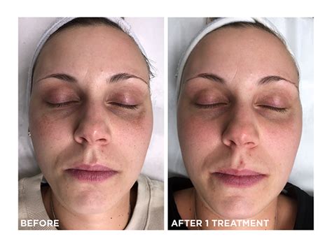 Photorejuvenation Photofacial Acne Rosacea And Melasma Treatment