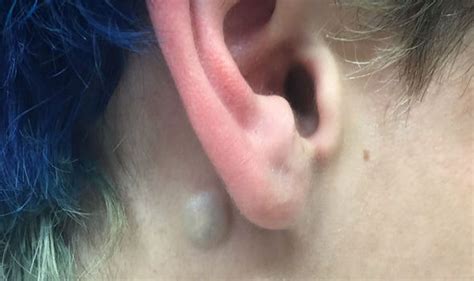 Lump Behind Ear Pictures Cyst Behind Ear Causes Treat