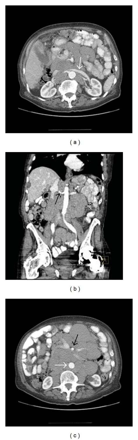 Axial A And Coronal B Contrast Enhanced Ct Of The Abdomen In A