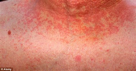 New Group A Strep Strain May Pose Global Scarlet Fever Threat