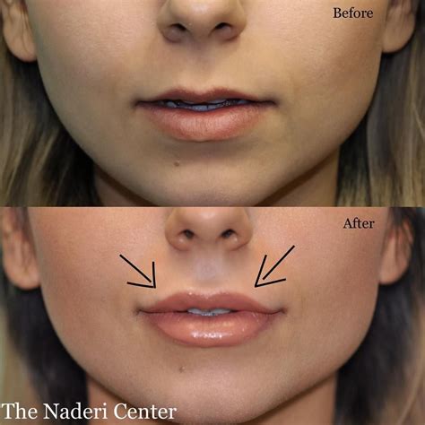 Non Surgical Lip Augmentation Of Thin Lips With Cc Of Juvederm Ultra