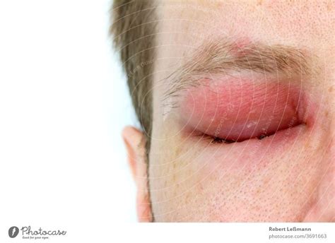 A Man With Swollen Eye From A Bee Sting A Royalty Free Stock Photo
