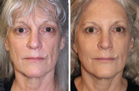 Patient 177905695 Facelift Before And After Photos Boston Center For