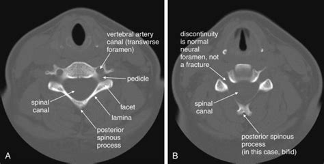 Imaging The Cervical Thoracic And Lumbar Spine Radiology Key