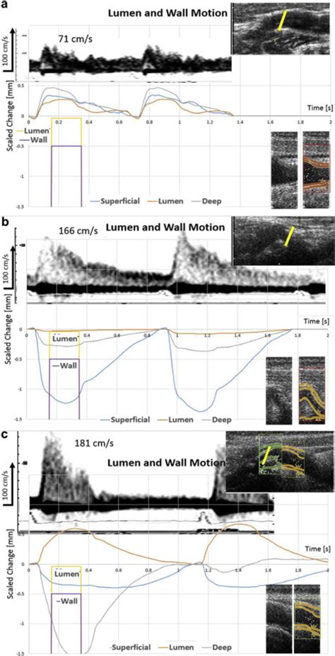 Spectral Doppler Blood Velocity With Diametric And Scaled Wall