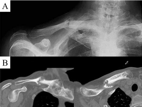 Figure 1 From Stress Fracture Of The Midshaft Clavicle Associated With