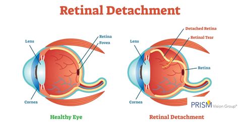What Is A Detached Retina The Eye Care Surgery Center