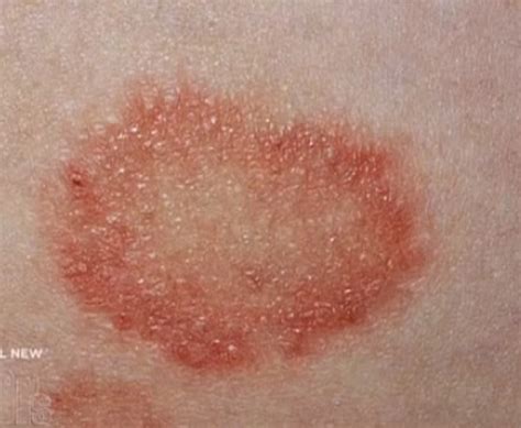 The Various Stages Of Ringworm Recognise Them And Deal With It Quickly