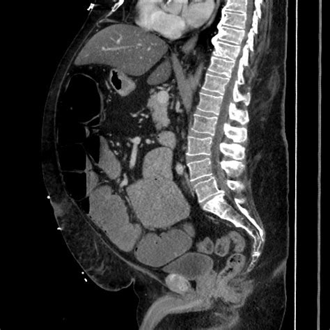Obstructive Colonic Diverticular Stricture Image