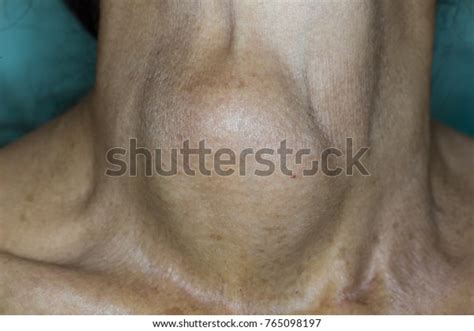 Zooming Closeup View Enlarged Thyroid Gland Stock Photo 765098197