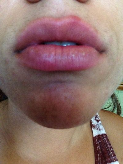 Do you know what are the reasons? What can I do to get rid of this red upper lip bump/ scar ...