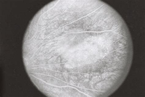 Metastatic Breast Cancer Retina Image Bank
