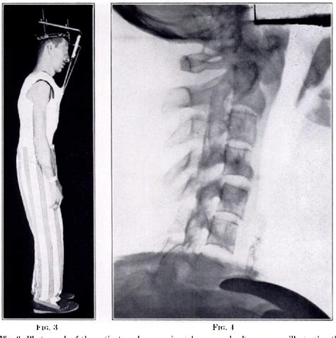 Figure 4 From Correction Of Severe Deformity Of The Cervical Spine In