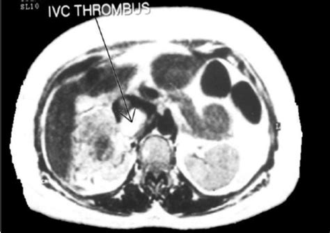 Contrast Enhanced Ct Of The Abdomen Showing An Amoebic Liver Abscess