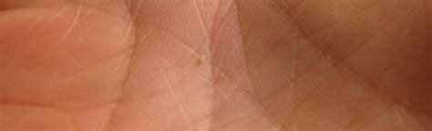 Small Skin Colored Bumps On Hands Small Bumps Under Skin Palm Of Hand