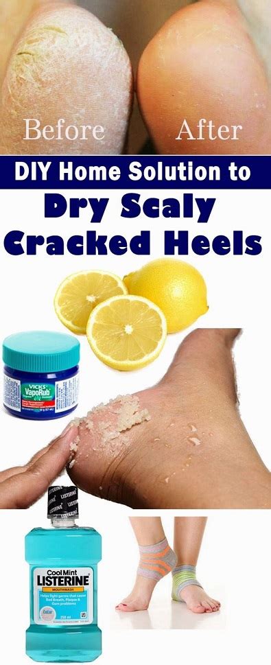 If your tootsies are dry with a capital d, reach for this guy. DIY Home Solution to Dry Scaly Cracked Heels - Style Vast