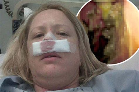 Flesh Eating Disease Made Actress Sneeze Off Her Nose Daily Star