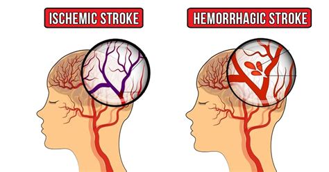 Here Are 7 Symptoms And Types Of Strokes In Women Born Realist