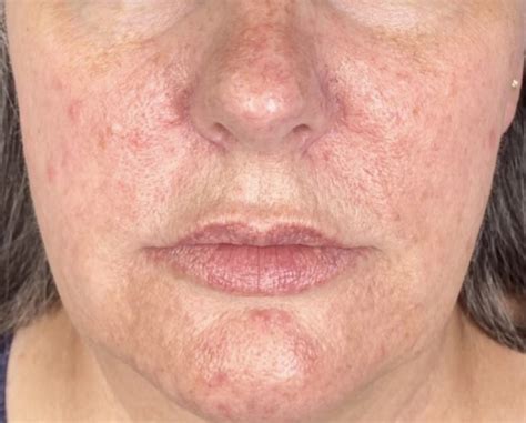 Acne Therapy In Lambertville Angie Scott