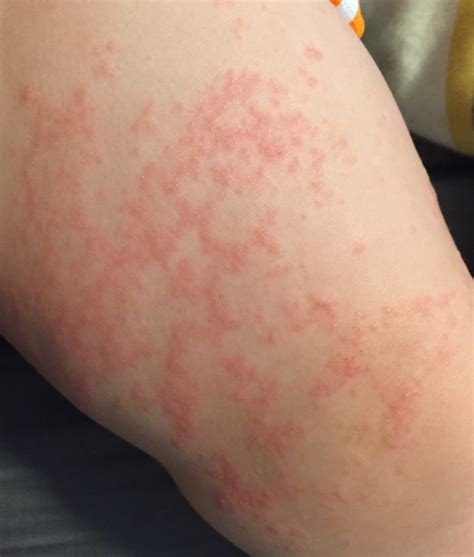 My 19 Month Old Son Has A Rash On Belly Migrating Down Towards Legs