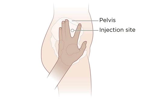 intramuscular injection definition and patient education patient education injections