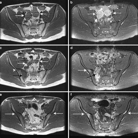 Case 2 A Axial T1w And B T1w Fse Mri With Fat Presaturation And