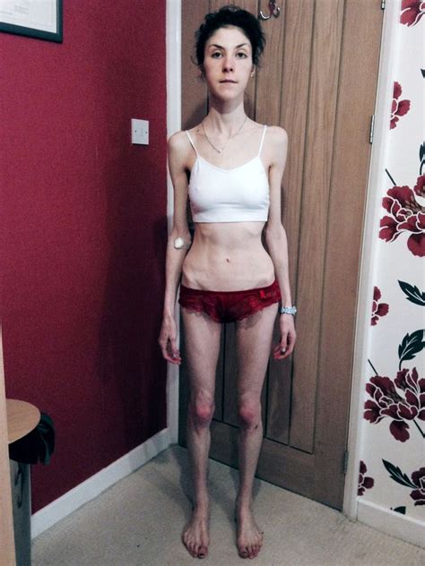 Amazing Transformation Of Anorexic Student Was Hours From Death After