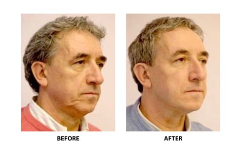 Boston Thread Lift Non Surgical Face Lift Before And After Dr Numa
