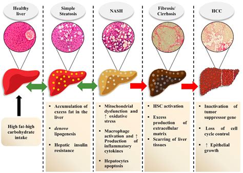 Beverages And Non Alcoholic Fatty Liver Disease Nafld Think Before