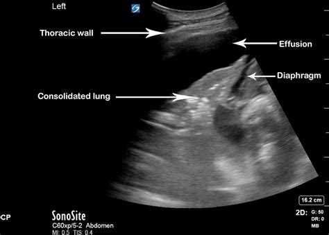 Lung Ultrasound A Useful Tool In The Assessment Of The Dyspnoeic