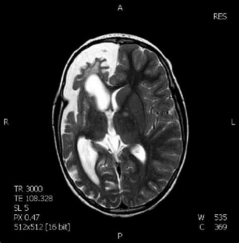 Right Cerebral Hemisphere Atrophy After Ischemic Lesion T2 Weighted Se