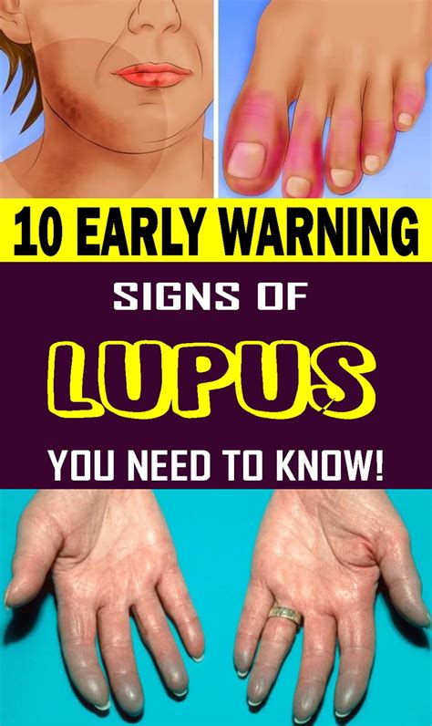 Here Are 10 Early Warning Signs Of Lupus You Need To Know Healthy