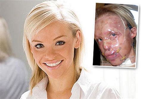 Acid Attack Model Katie Piper Reveals She Wanted To Die After Burns
