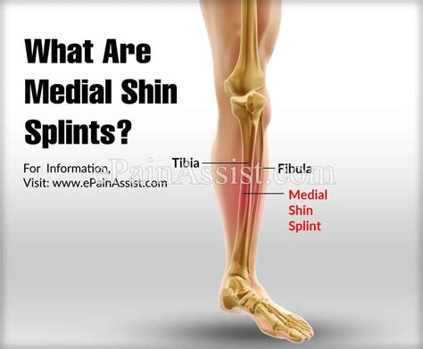 What Are Medial Shin Splints