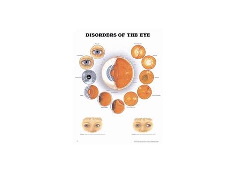 Disorders Of Eye Anatomical Chart Medicvision As