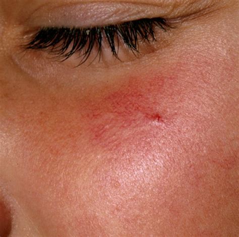 Spider Angioma Symptoms Causes Pictures Treatment 2018 Updated