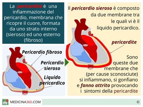 A pericardite aguda é a inflamação repentina do pericárdio, que dura aproximadamente duas semanas, em média. Pericardite: sintomi, cause e terapia per l'infiammazione ...