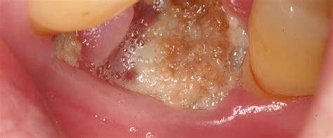 Signs Of Infection After Tooth Extraction