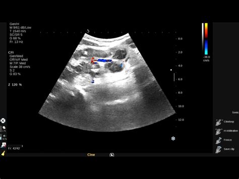 Vietnamese Medic Ultrasound Case 575 Lymph Node Tuberculosis Dr Phan