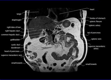 Anatomy Human Abdomen MRI Abdomen Coronal Anatomy Free Cross Sectional Anatomy Mri