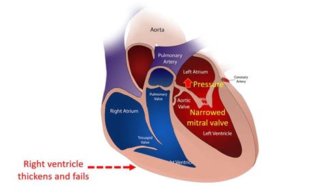 Mitral Stenosis All About Heart And Blood Vessels