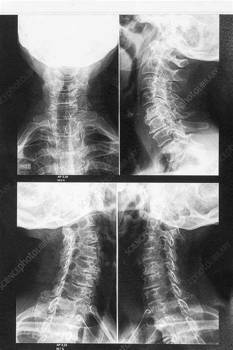 Osteoarthritis Of The Neck X Ray Stock Image C0368206 Science