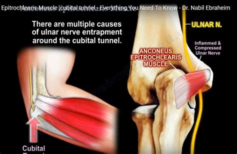 Anconeus Muscle And Cubital Tunnel Syndrome OrthopaedicPrinciples Com
