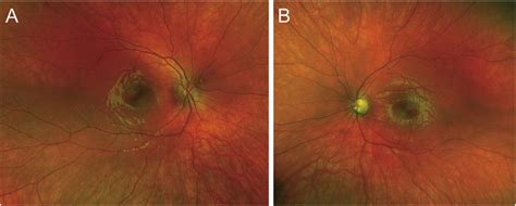 Bilateral Fundus Examination Revealed A Normal Findings In The Right