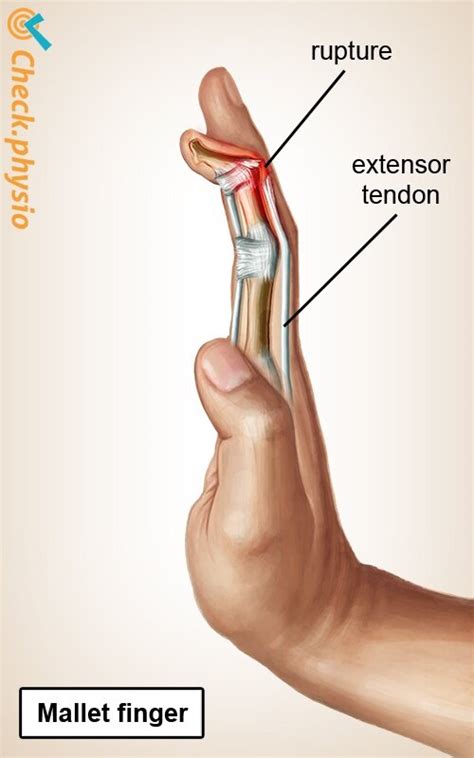 Mallet Finger What It Is And How To Heal It Creekside Physiotherapy