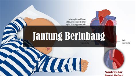 Jantung Berlubang Punca Simptom And Rawatan Root Of Science